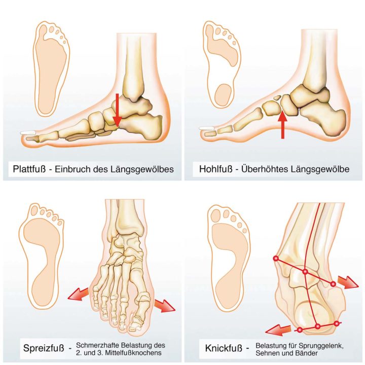Fehlstellung der Füße. Belastung bei Hohl-, Platt-, Spreiz- und Knickfuß.